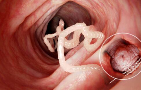червь - паразит в организме человека